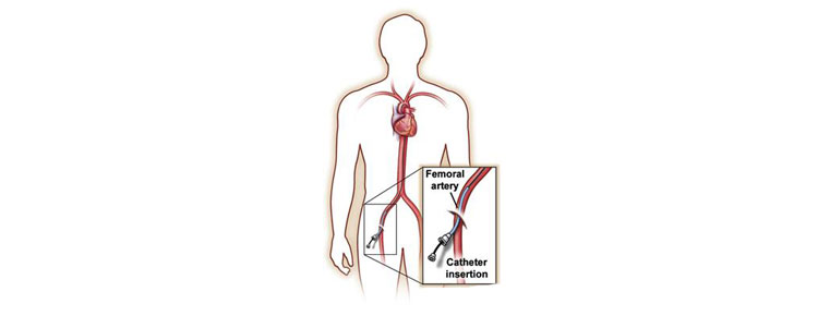 Angiogram
