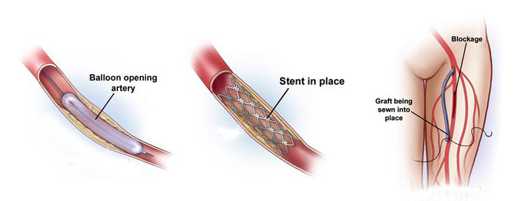 Atherosclerosis
