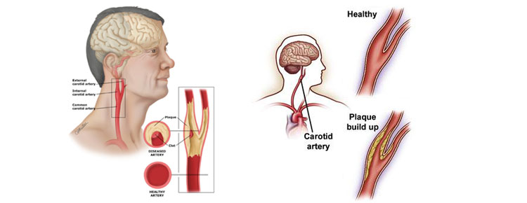Carotid Artery Surgery