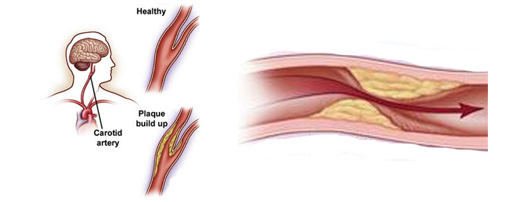 Carotid Endarterectomy