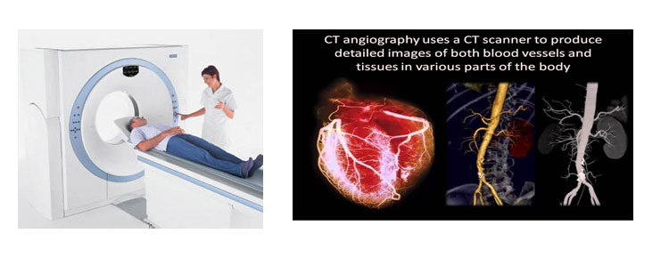 Computed Tomography Angiography