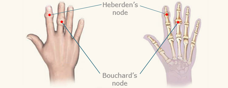 Connective Tissue Disorder