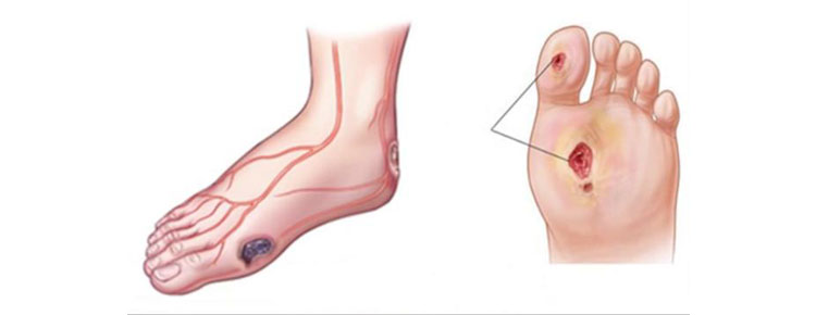Diabetic Foot Care