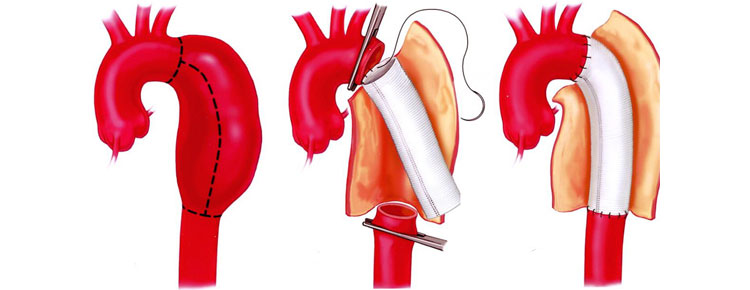Open Surgery Treatment of an Aortic Dissection