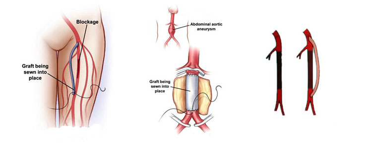 Surgical Bypass